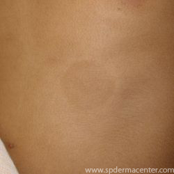 Vitiligo-treated